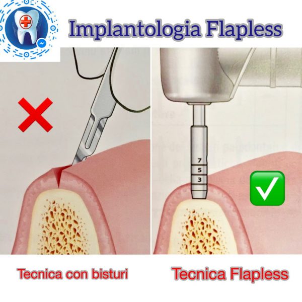 trattamento-flapless-napoli
